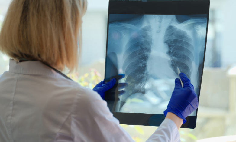 Lung-Cancer Lung Cancer