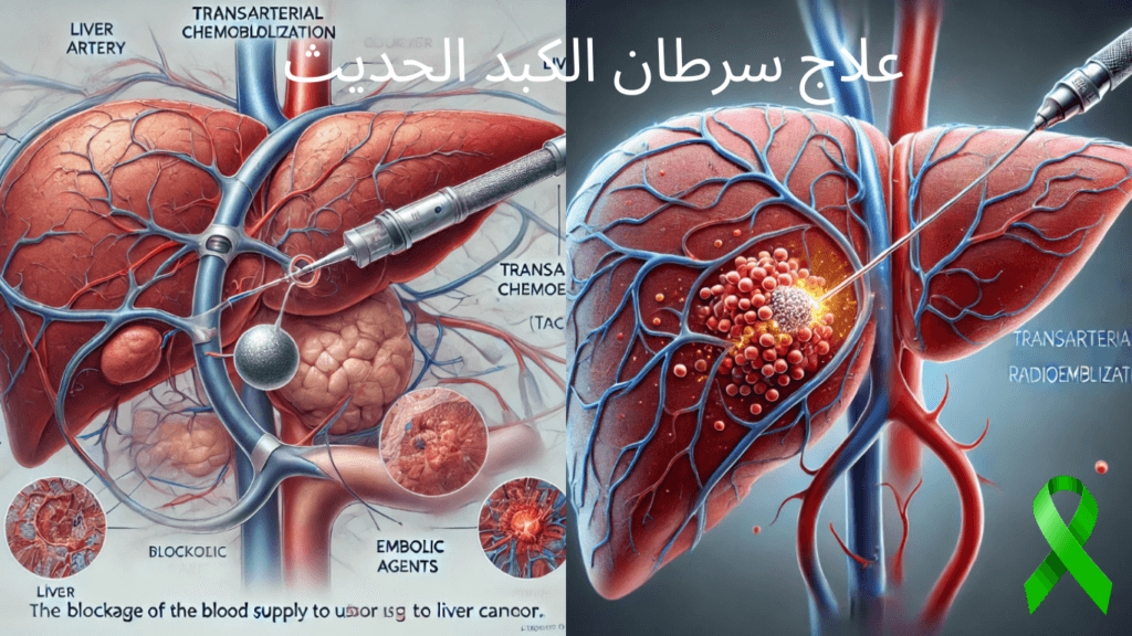 علاج سرطان الكبد الحديث