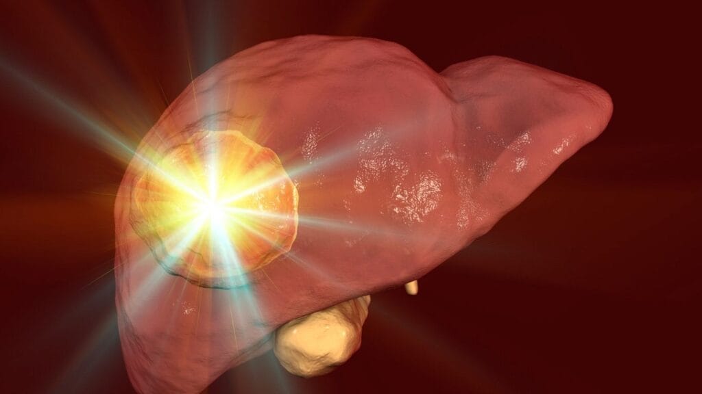 تكلفة علاج سرطان الكبد في الهند